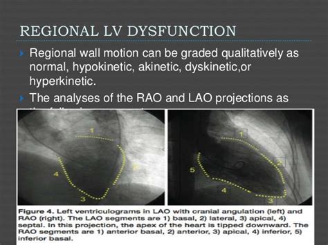 lv angiography|mitral valve area by catheterization.